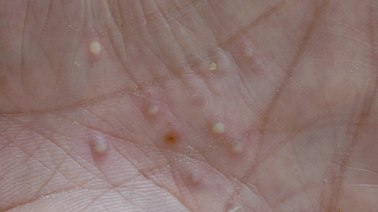 Palmoplantar