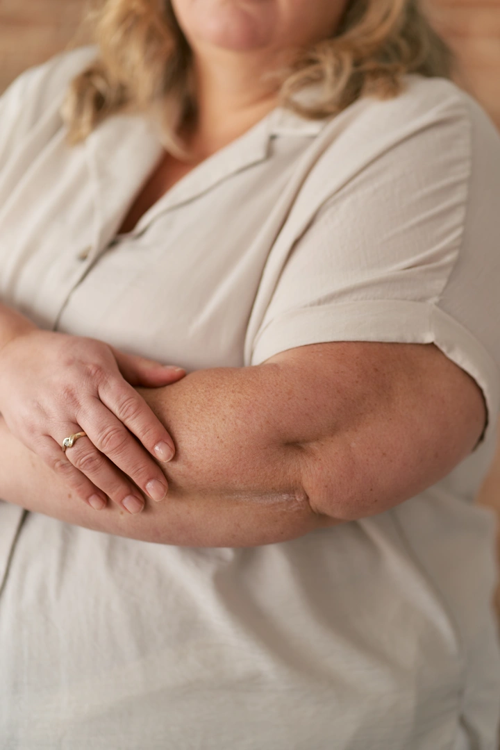 psoriasis