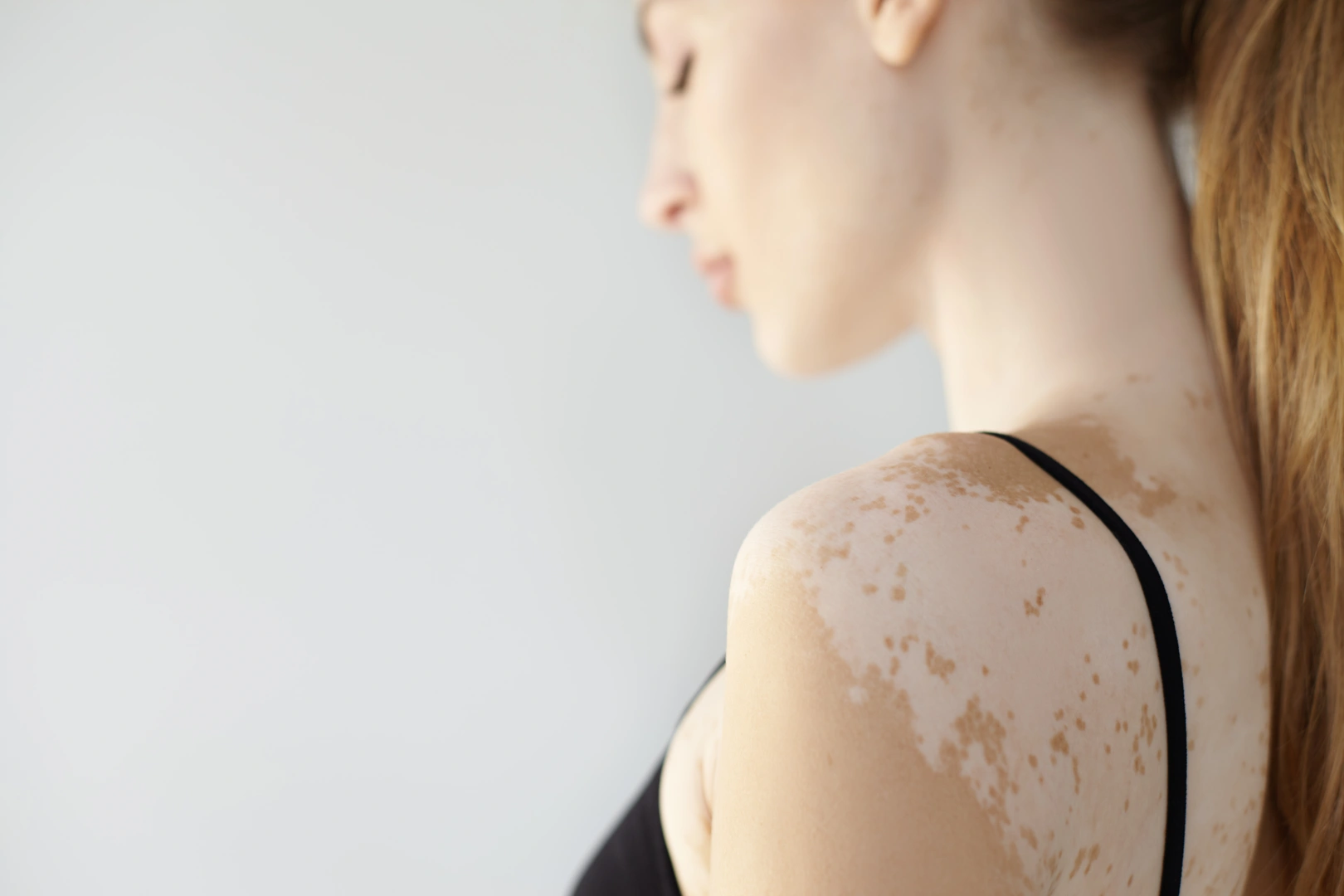 vitiligo