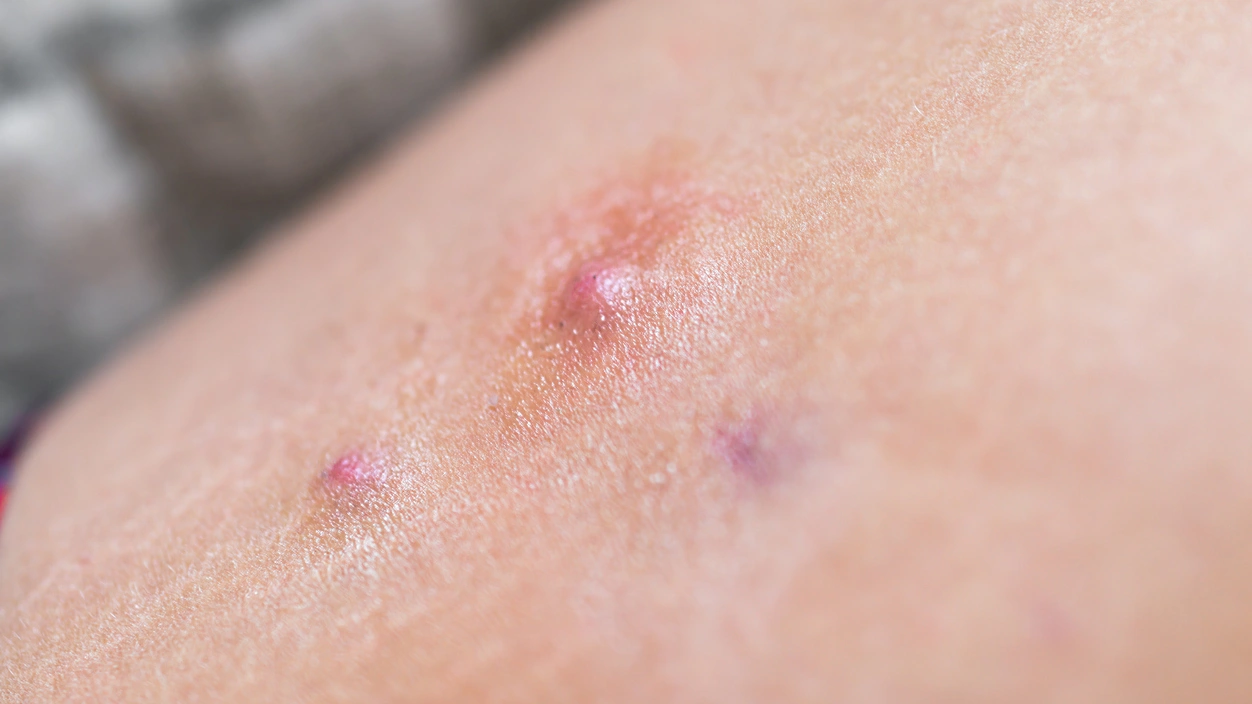 hidradenitis-suppurativa