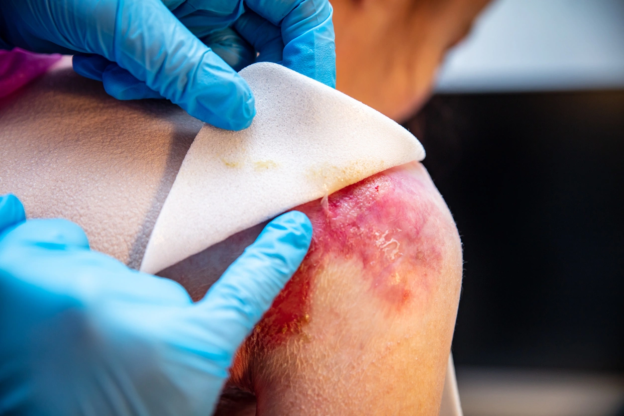 epidermolysis-bullosa